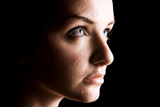 Adult Acne: How to Control Blemishes & Breakouts in Your Middle Years