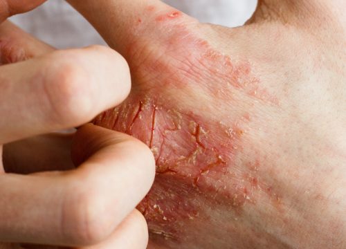 Eczema