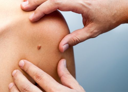 A mole on a woman's body
