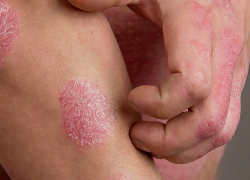 Psoriasis