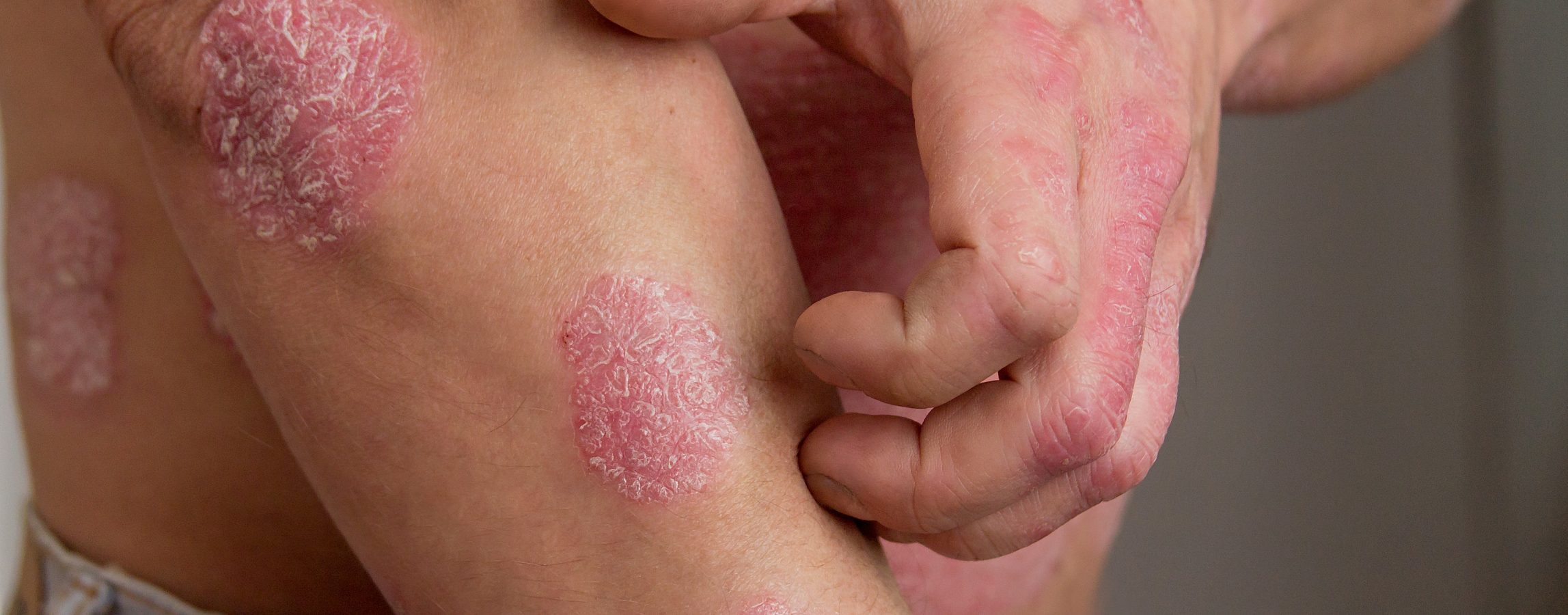 Psoriasis