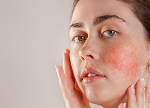 Woman with rosacea