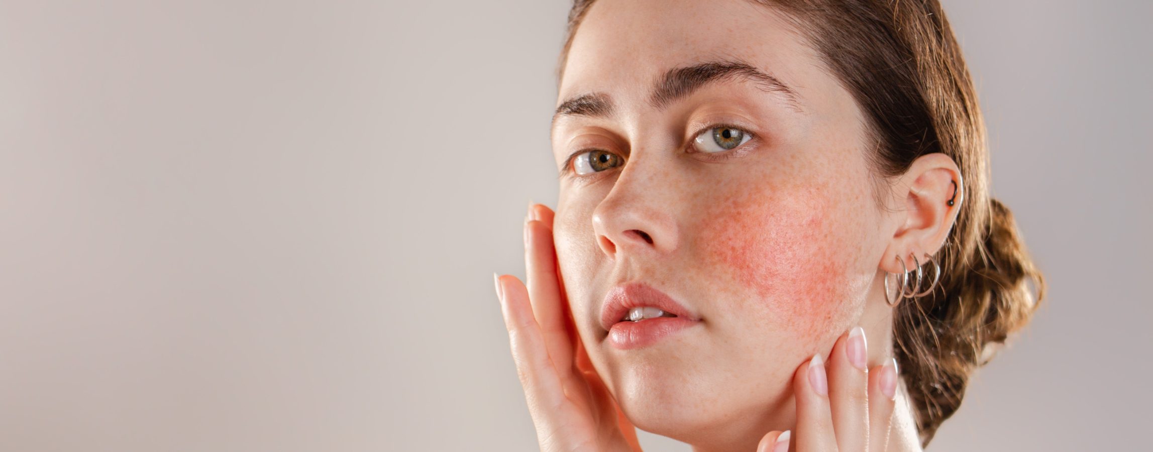 Rosacea