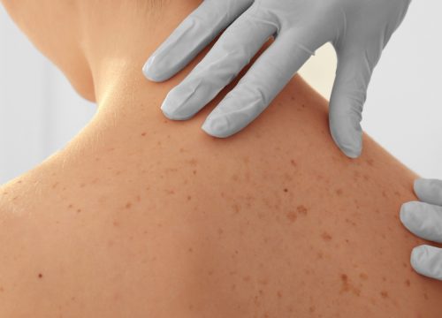 Dermatologist checking for skin cancer