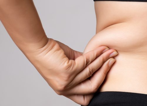 Unwanted fat on a womans hip area