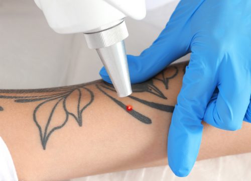 Laser tattoo removal