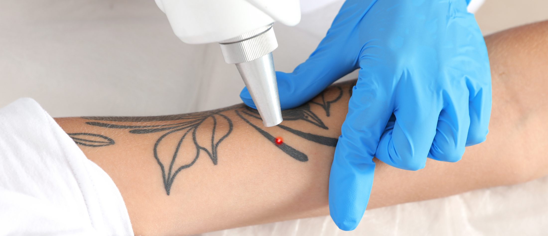 Laser Tattoo Removal