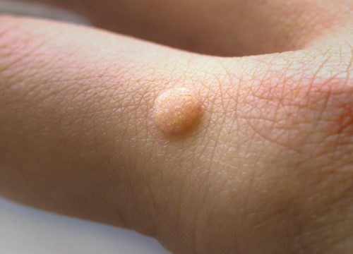Warts on a persons hand