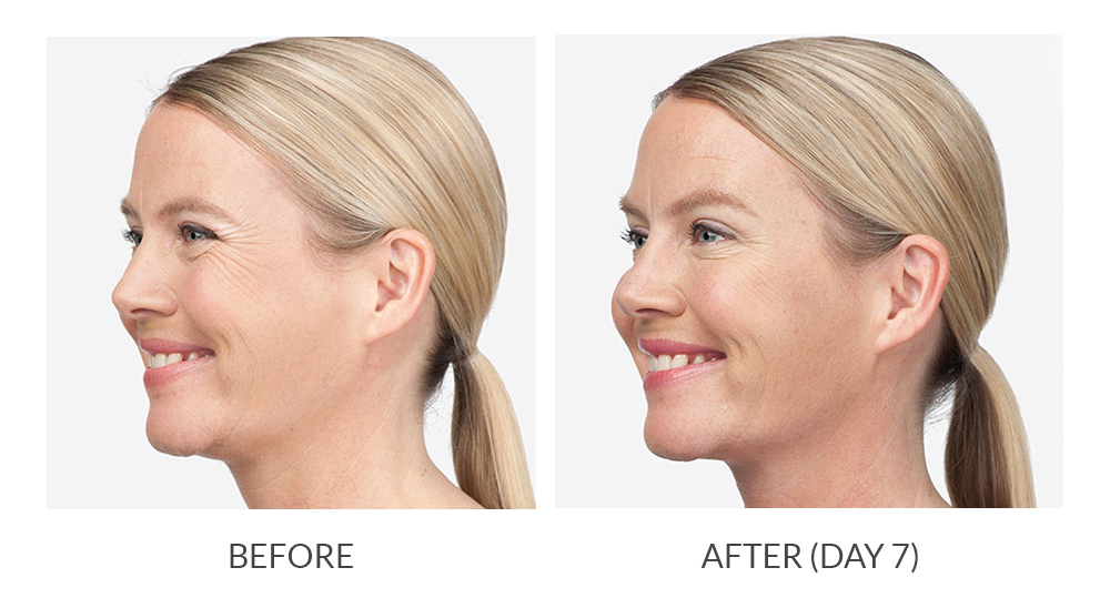 Before and after BOTOX® Cosmetic results
