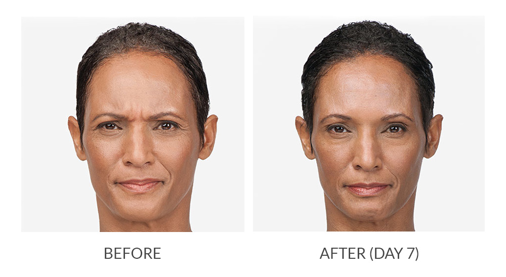 Before and after BOTOX® Cosmetic results