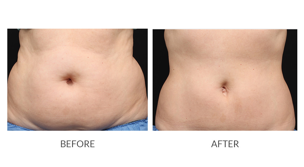 Before and after CoolSculpting® results