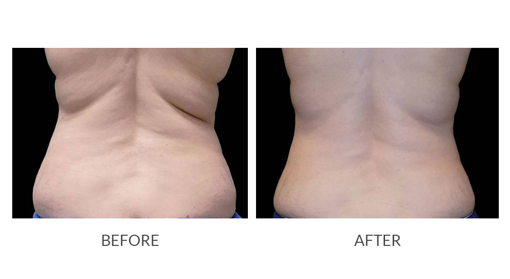 Before and after CoolSculpting® results