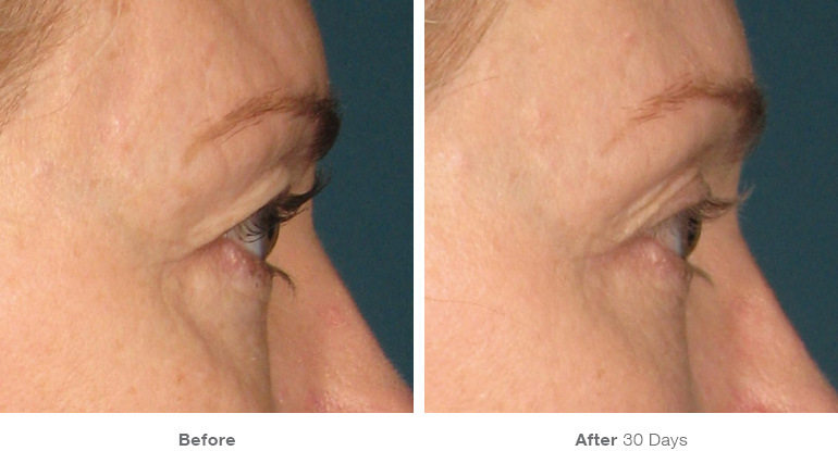 Before and after Ultherapy results