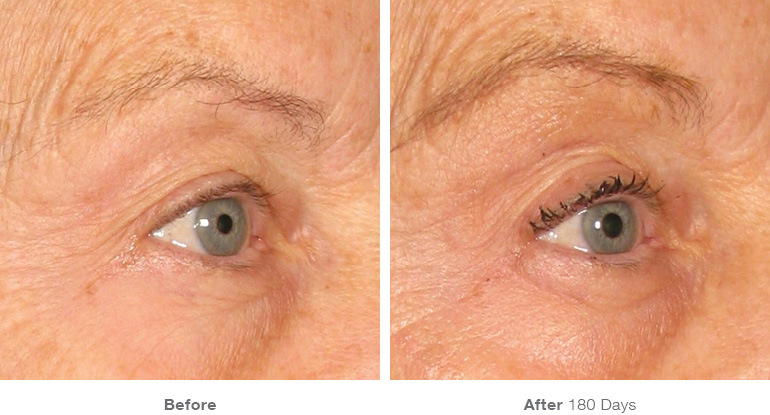 Before and after Ultherapy results