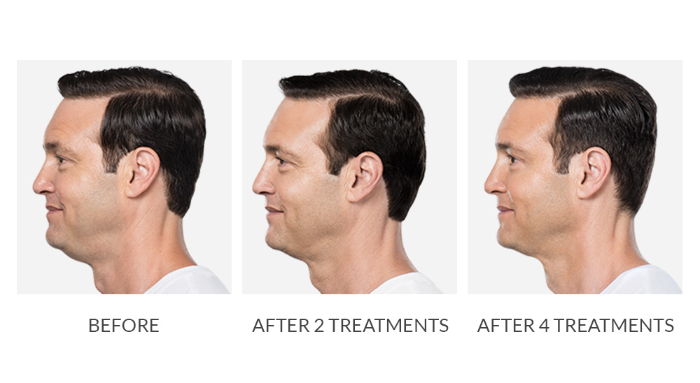 Before and after Kybella results