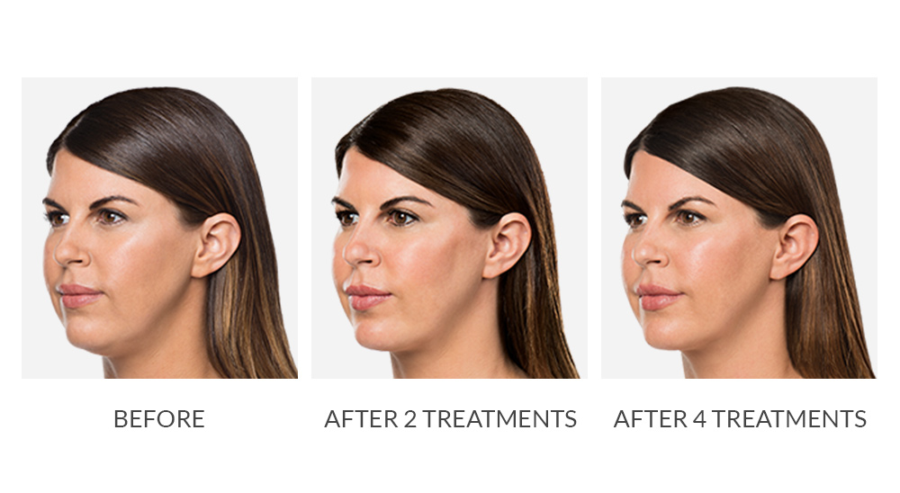 Before and after Kybella results