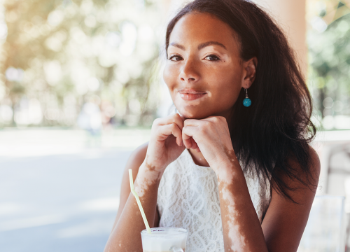 Woman with vitiligo